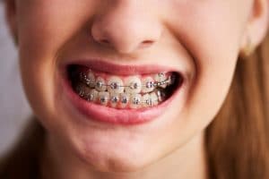 North Garland Dental and Orthodontics - Braces - Kid with braces